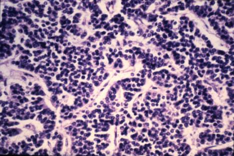 Neuroendocrine Tumors Arise from cells in the diffuse neuroendocrine system throughout the body May pursue a more indolent