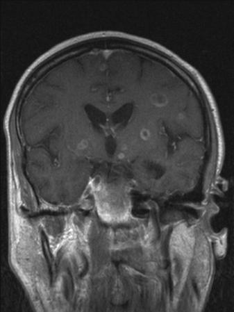 Case 39 yr male, presents to ER with seizures New Diagnosis of HIV