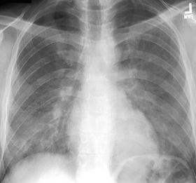 PCP: Imaging 6/05 Chest x ray: PCP pneumonia with