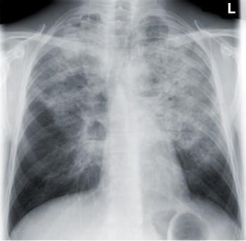 Credit: L, Huang, MD, HIV InSite Chest x ray: PCP