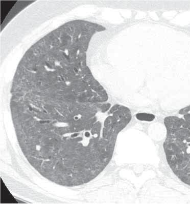 a) b) c) FIGURE 1 a) High-resolution computed tomography (HRCT) pattern inconsistent with usual interstitial pneumonia
