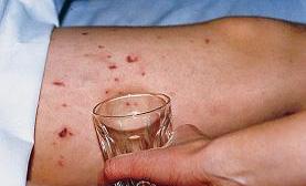 Meningitis / Septicaemia Rash GLASS TEST A rash that does not fade under pressure will still be visible when the side of a clear glass is pressed firmly against the skin Images provided by the