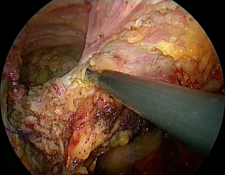 Annals of Laparoscopic and Endoscopic Surgery, 2017 Page 13 of 15 plane between the rectum and the prostate (male), or the vagina (female).