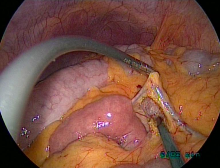 position. Figure 6 SAL (single-access laparoscopy): surgeon s ergonomics view.