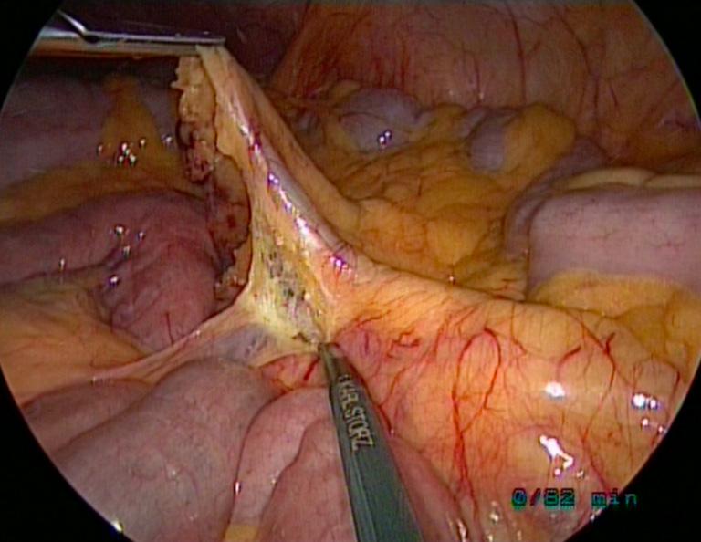 Once the upper mesorectum is freed, the dissection Figure 7 SAL (single-access laparoscopy):