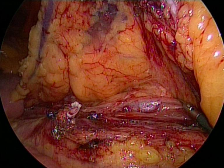 mesenteric artery section.