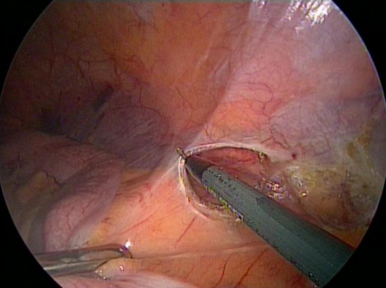 the upper rectum from the presacral fascia in an avascular