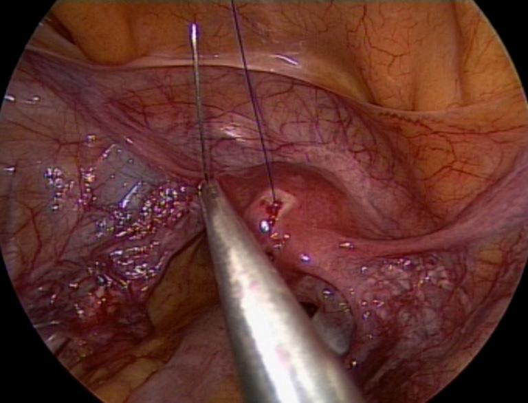 Figure 12 SAL (single-access laparoscopy): temporary