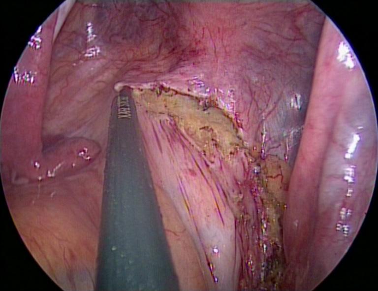 Figure 17 SAL (single-access laparoscopy): temporary