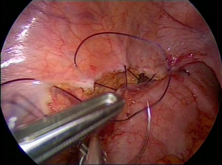 Figure 24 SAL (single-access laparoscopy): right