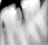 Figure 1 Pre operative radiograph Figure 2 Working Length Estimation Radiograph The tooth was anesthetized using two percent lignocaine with 1:80,000