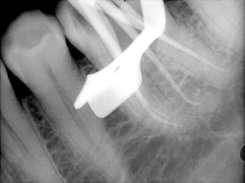 The root canals were irrigated with normal saline and stirred with number 25 K file (Maillefer Dentsply) to remove the intracanal medicament. Final irrigation of the canals was done with 2.