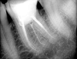 The angled radiograph was taken which revealed the presence three roots and six canals.