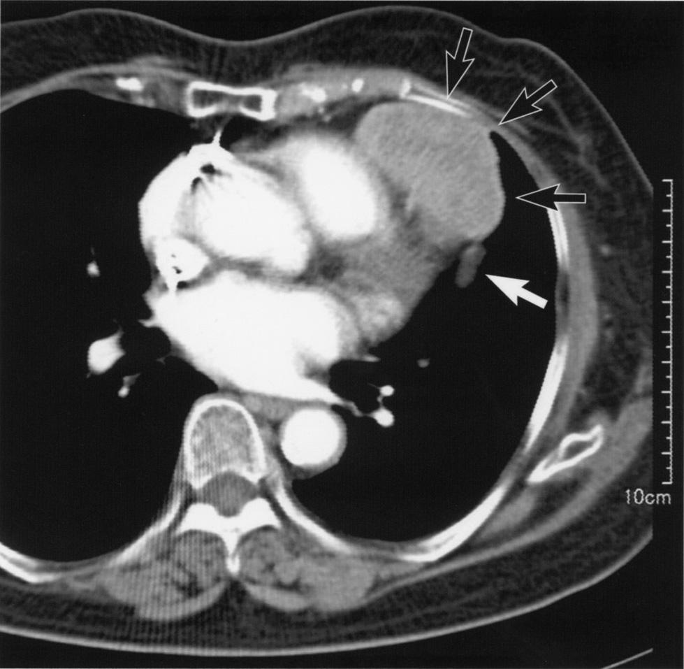 Cystic degeneration was observed. Necrotic or hemorrhagic portions were absent. Fig. 2. Computed tomography shows a large mass in the anterior mediastinum (black arrows).