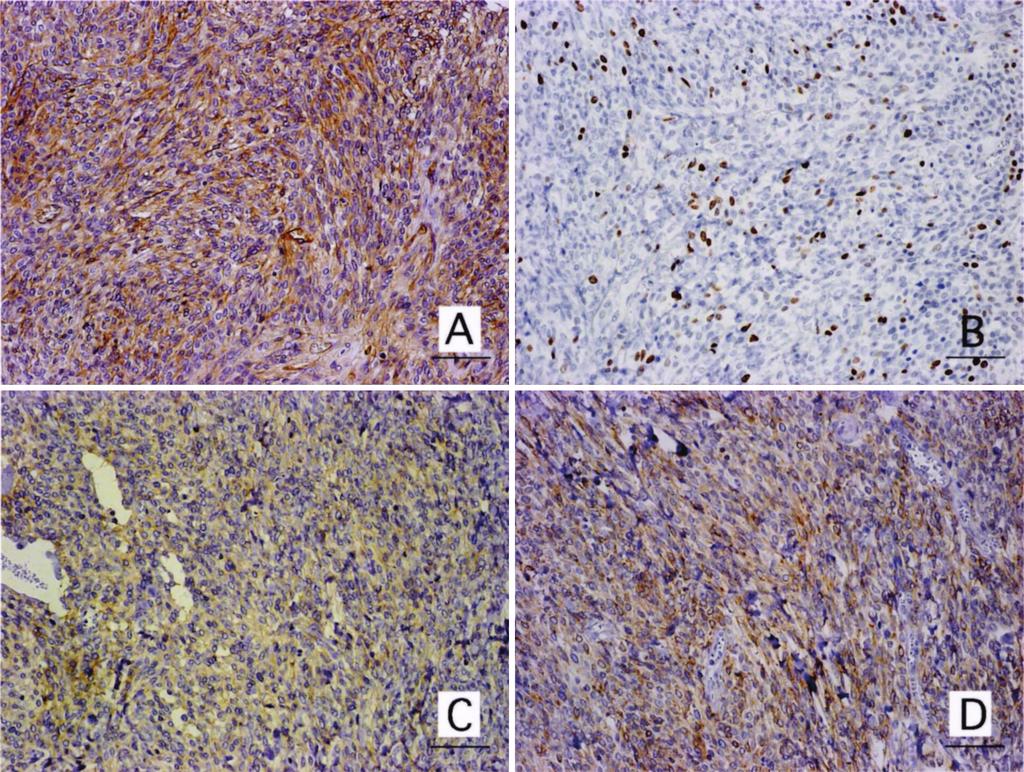 spindle or round tumor cells in the collagenous background. Fig. 5. Results of immunohistochemical staining (original magnification 200).