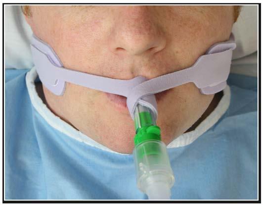 Comfort-Fix Comfort-Fix tube holders provide a secure method of holding endotracheal and tracheostomy tubes in position.