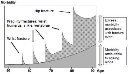 intervention Hip fracture is all too often the final destination of a thirty year journey fuelled by decreasing bone