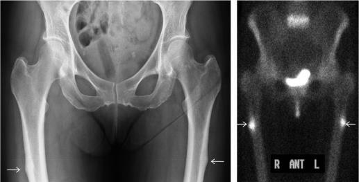 ) Bilateral fractures present in % ( of 15) Bilateral radiological changes present in % (3 of ) Delayed