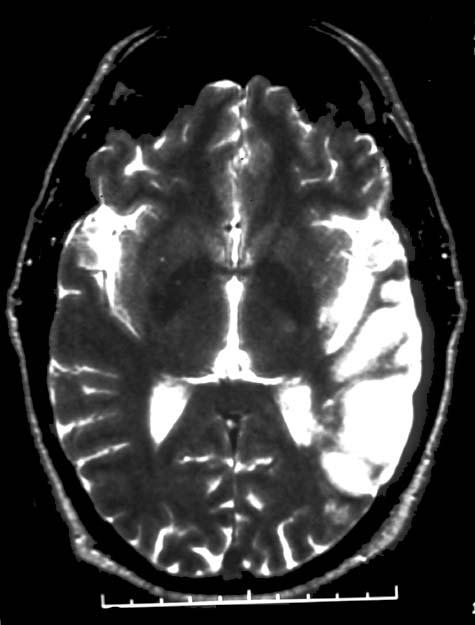 The arrow indicates the region supplied by the middle cerebral artery.
