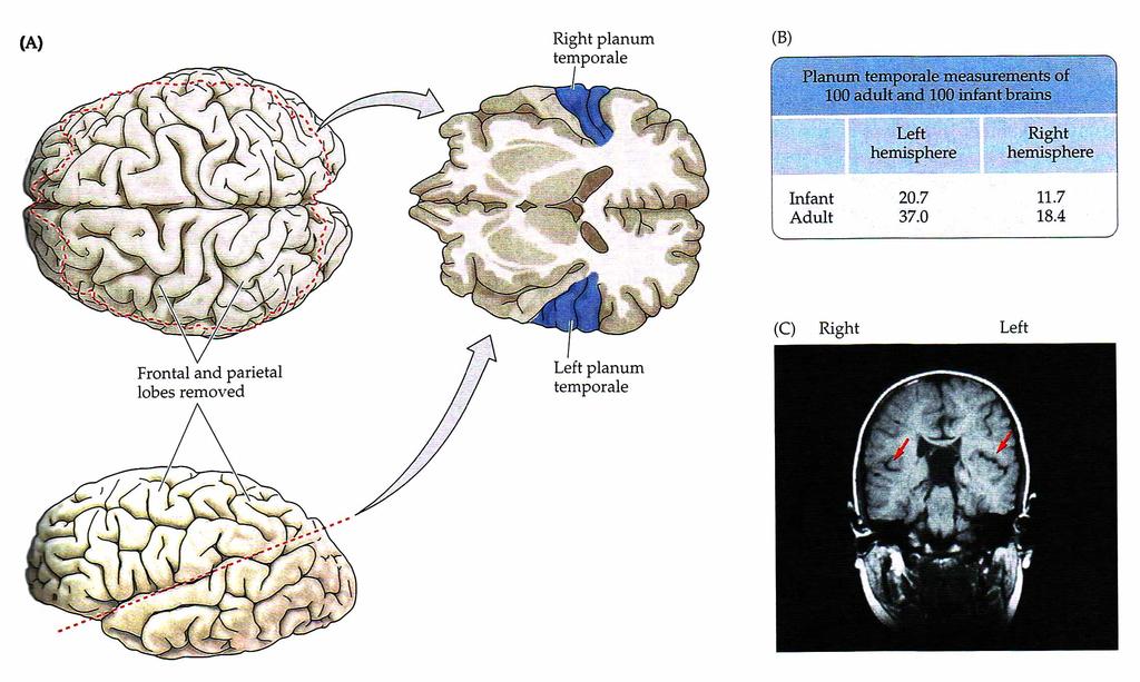NEUROSICIENCE, fig 27.4 (p 619) The auditory cortex of humans (planum temporale) is asymmetrical. Usually left > right.