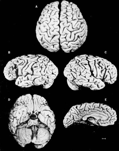 43 44 Einstein s brain weight was not different from that of controls and the gross anatomy of his brain was within normal limits with the exception of his parietal lobes.