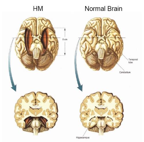 H.M. Effects of Bilateral Medial Temporal Lobectomy Minor seizure beginning at age 10, major seizures beginning age 16 Severe, persistent seizure condition- not controlled with anticonvulsants By