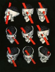 Phineas Gage Extensive damage to medial prefrontal and orbitofrontal cortex Responsible for The balance Gage lacked the cortex necessary to inhibit his emotional responses But