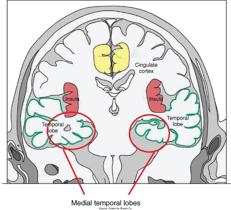 The Medial Temporal Lobe: Crucial in the Declarative Memory System n Damage to these areas usually results in