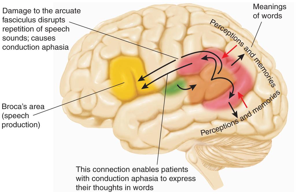 Conduction aphasia Anomic aphasia n Speech of anomic aphasics is fluent and grammatical, and their comprehension is fine but they appear to have difficulty finding the