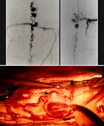 intradural perimedullary AVF with varices that were fed by the posterior spinal artery, which came from the intercostal artery at the right T-9 level (Fig. 1 upper left).