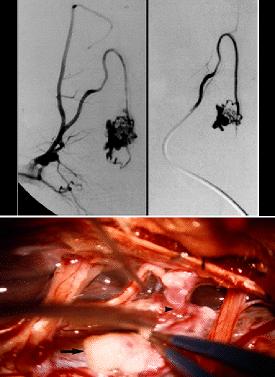 Fig. 4. Case 13. Imaging study. Upper Left: Spinal angiogram, anteroposterior view, of right thyrocervical trunk showing filling of anterior spinal artery and perimedullary AVF.