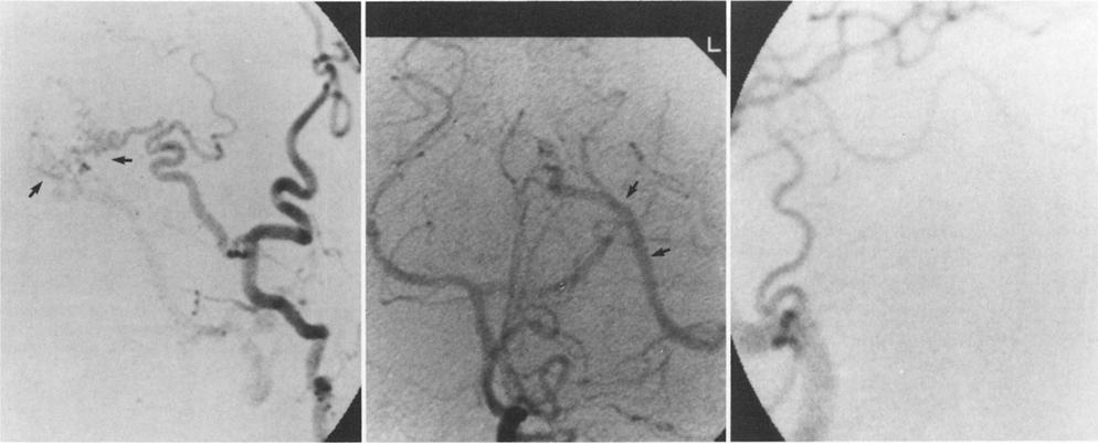 S. L. Barnwell, et al. FIG. 1. Angiograms in Case 14. Left: Angiogram of the left occipital artery, anteroposterior projection, showing a straight sinus dural arteriovenous fistula (arrows).