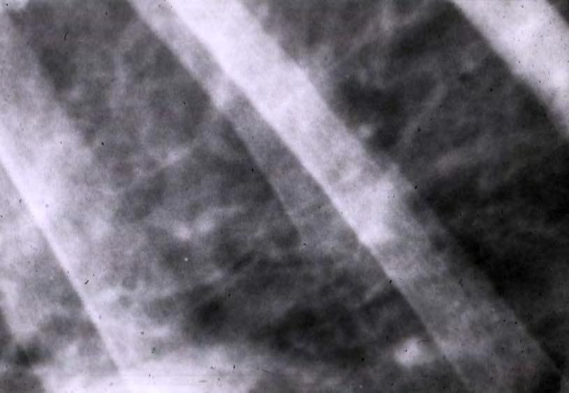 Pulmonary Interstitial Fibrosis
