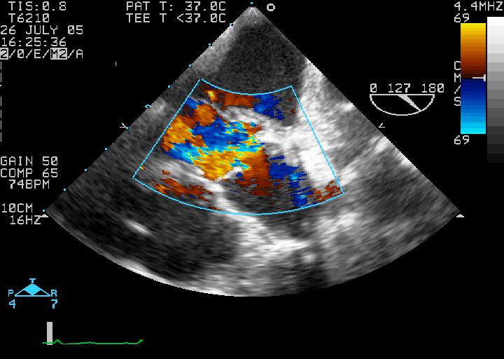 60 yr old female, severe AR for AVR Intra-operative TOE not strongly indicated (Class II indication-2003 ACC/AHA/ASE guidelines) Ionescu AA, et al.