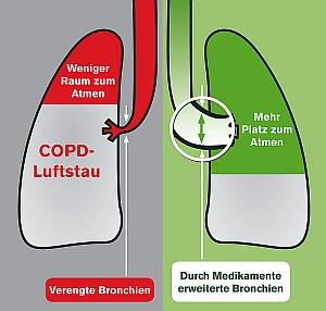 Main Lung diseases Emphysema Characteristics: Shortness of breath due to damaged air sacs (alveoli). Usually caused by chronic bronchitis.