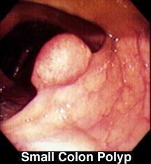 Colon Cancer 95% colon cancers develop
