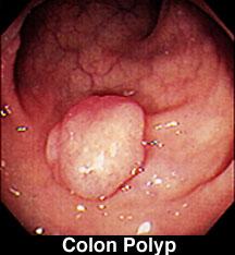 !. About 2/3 of polyps are Adenomas which