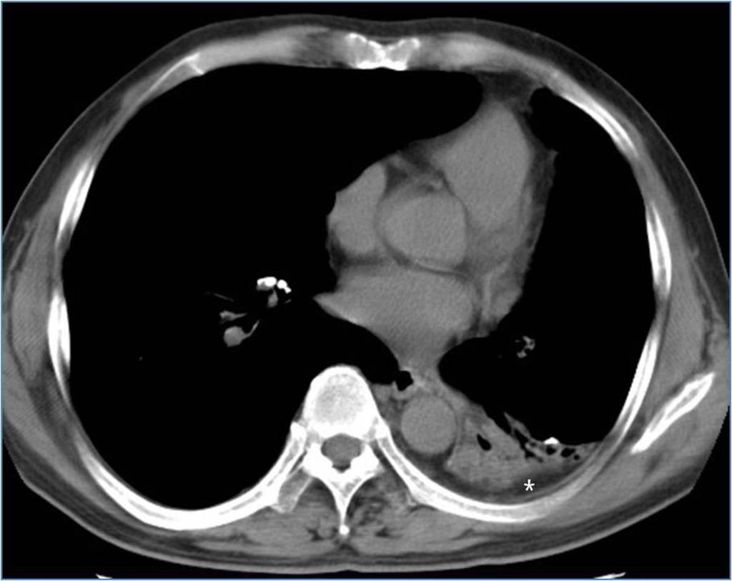 Fig.: 7. Left lower lobe collapse with decreased lung volume in a 55-year-old man.