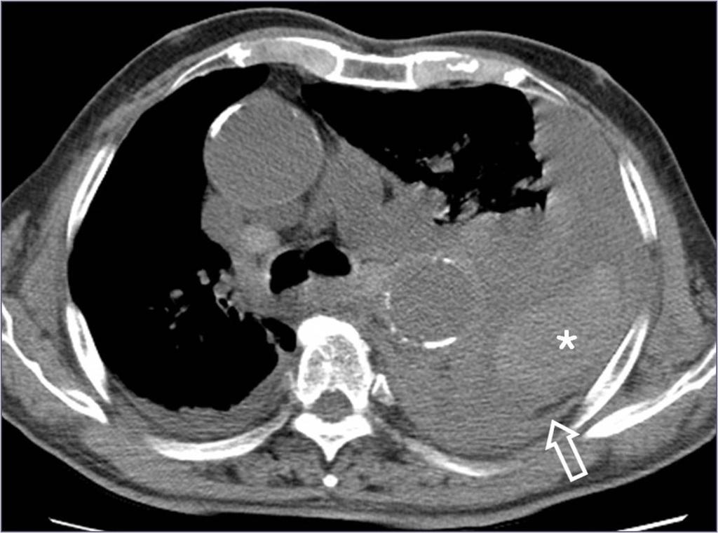 commonly accompanied by extrapleural hematoma. It is distinguished from extrapleural hematoma by the displaced extrapleural fat (7) (Figs. 8 ~ 10). Fig.: 8.