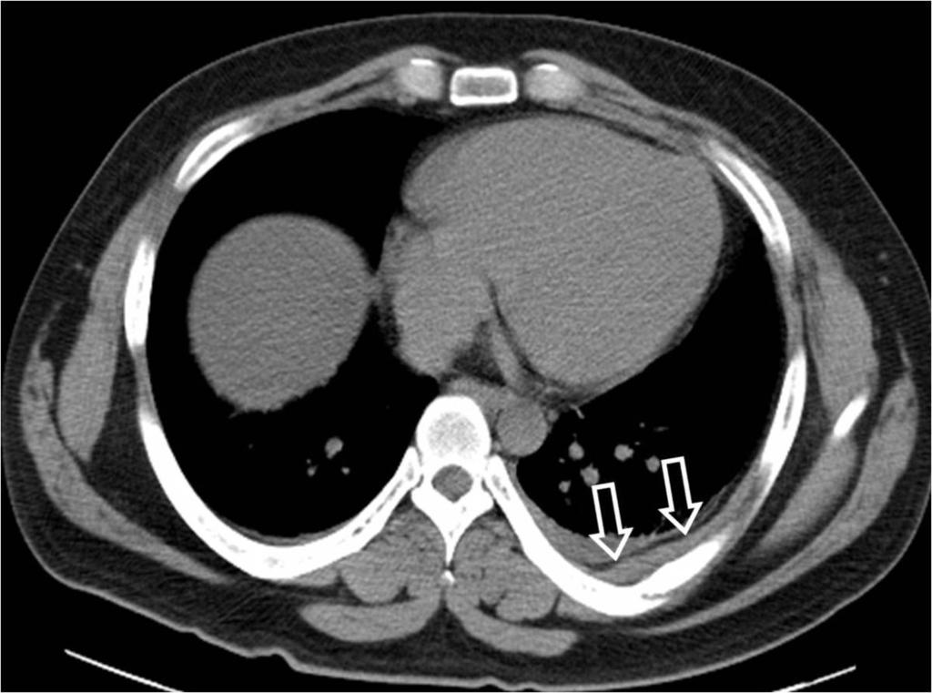 Fig.: 9. Extrapleural hematoma associated with rib fracture in a 32-year-old man.