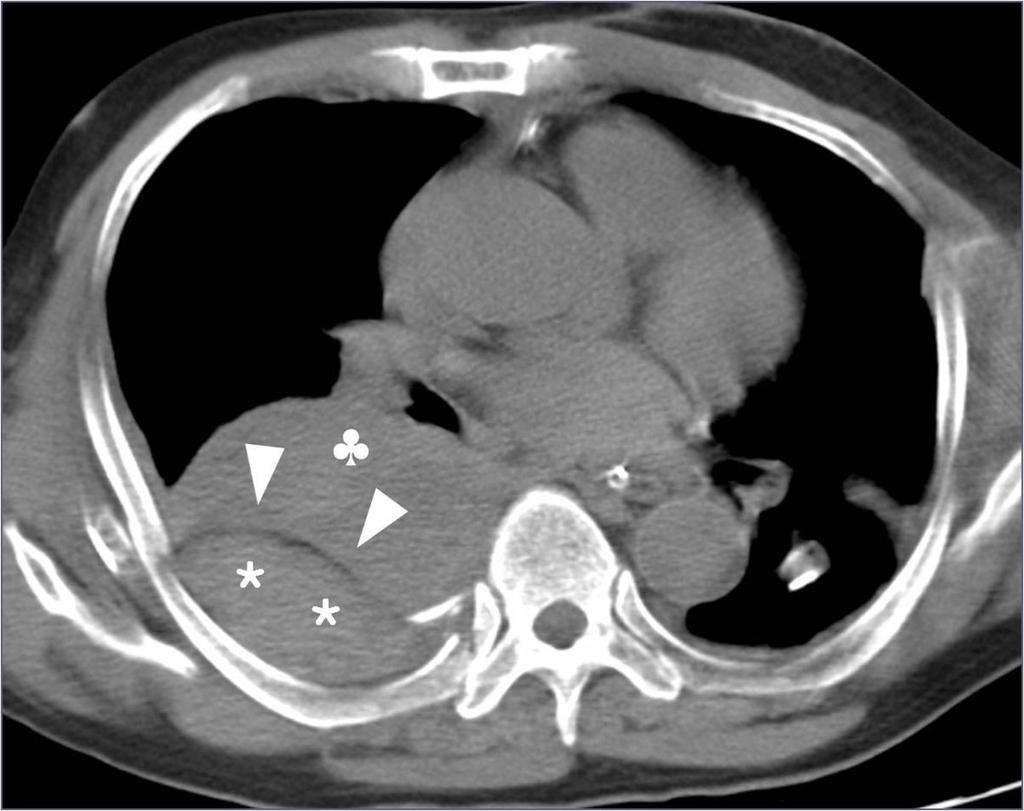 Fig.: 10. Extrapleural hematoma from chest trauma in a 57-year-old man.