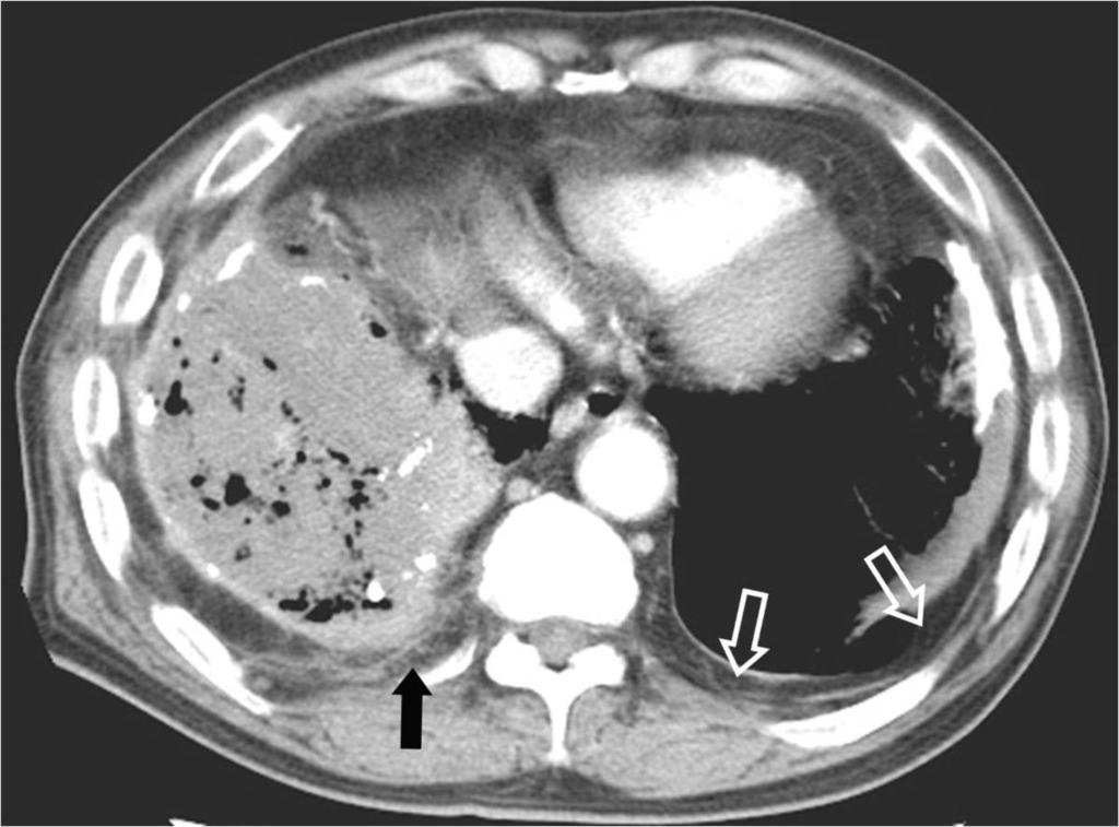 Fig.: 11. Extrapleural extension from empyema in a 80-year-old man.