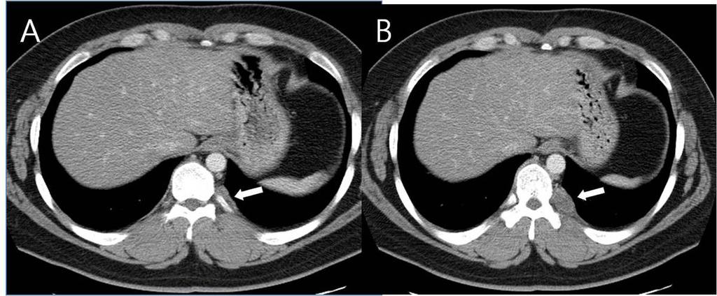 Fig.: 13. Extrapleural extension from empyema in a 61-year-old man. A, B.