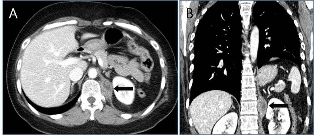 Fig.: 15. Extrapleural metastasis from thymic carcinoma in a 35-year-old woman. A, B.