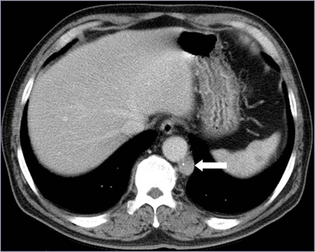 Fig.: 16. Extrapleural lymph node involvement of lymphoma in a 60-year-old man.