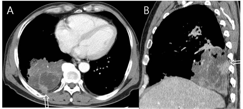 Fig.: 18. Extrapleural metastasis from lung cancer in a 68-year-old woman. A, B.