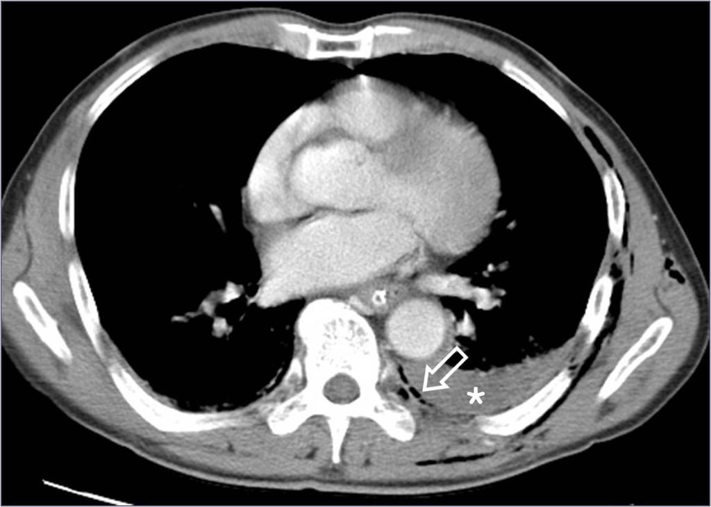 Air containing extrapleural lesions Extrapleural air caused by trauma Pleural injury is common in patients with chest trauma.