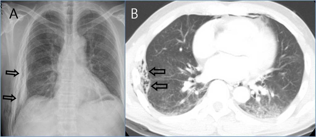 Fig.: 3. Extrapleural air caused by direct chest trauma in a 55-year-old man. A. Chest radiograph shows extraplueral air and hematoma (open arrows). B.