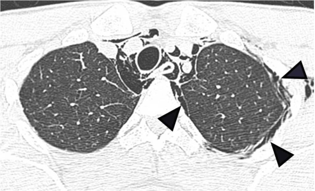 Fig.: 4. Extrapleural extension from pneumomediastinum in a 29-year-old man.
