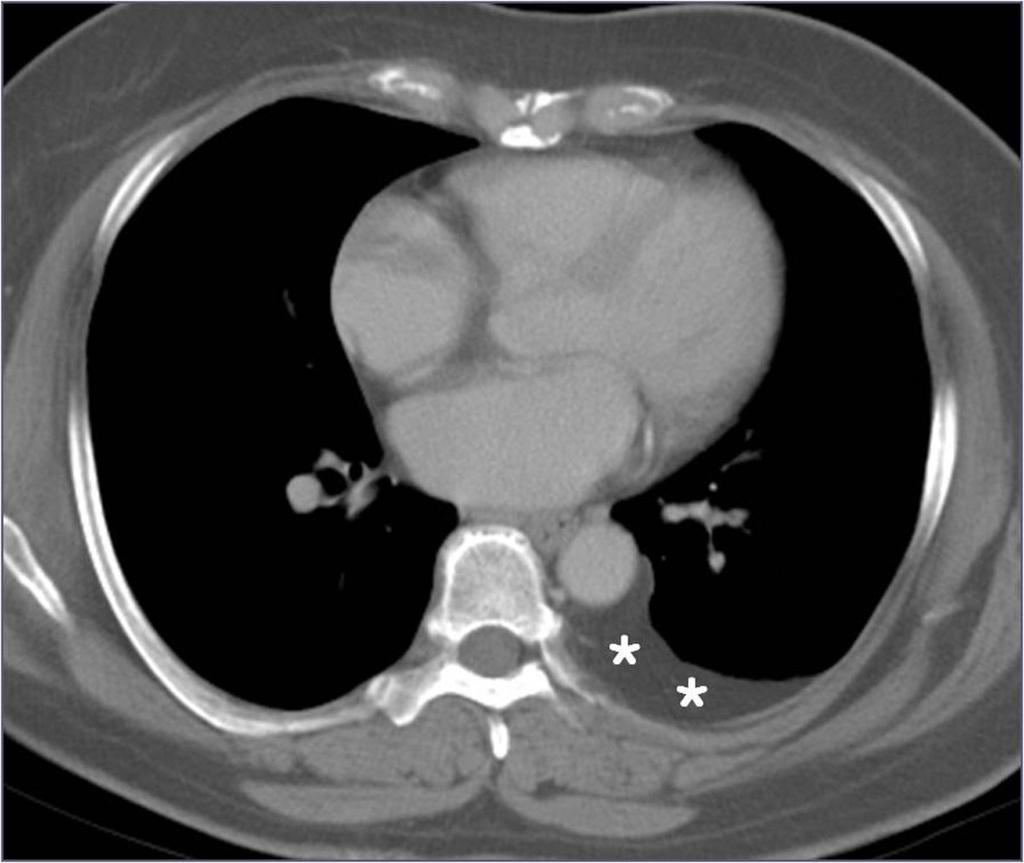 Fig.: 5. Unilateral extrapleural fat in a 63-year-old woman.